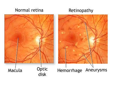 hogyan lehet javítani a látás élességét gyakorlat a hyperopia kezelésére